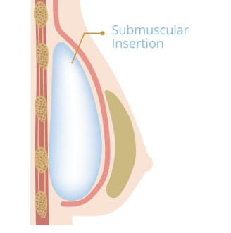 breast implant placement