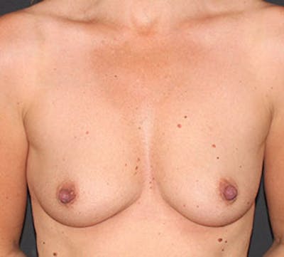 Breast Augmentation Before & After Gallery - Patient 149119507 - Image 1