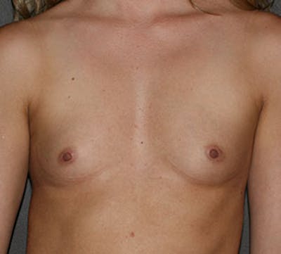Breast Augmentation Before & After Gallery - Patient 149119562 - Image 1