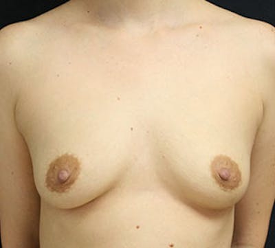 Breast Augmentation Before & After Gallery - Patient 149119575 - Image 1