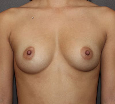 Breast Augmentation Before & After Gallery - Patient 149119603 - Image 1