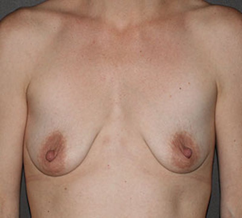Breast Augmentation Before & After Gallery - Patient 149119691 - Image 1