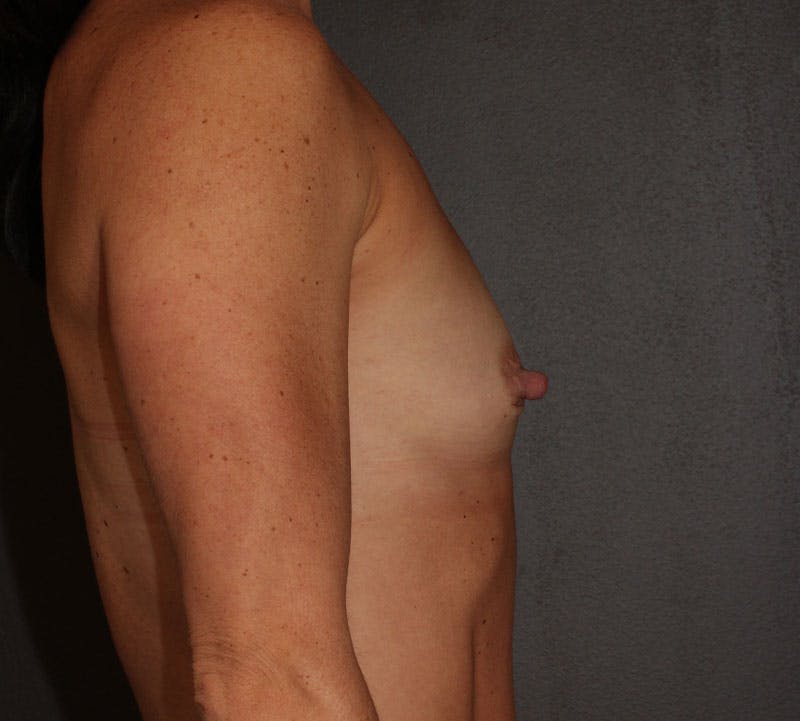 Breast Augmentation Before & After Gallery - Patient 304007 - Image 5
