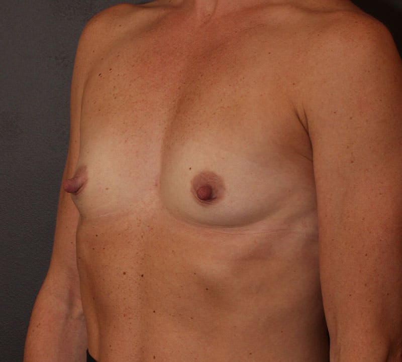 Breast Augmentation Before & After Gallery - Patient 304007 - Image 9