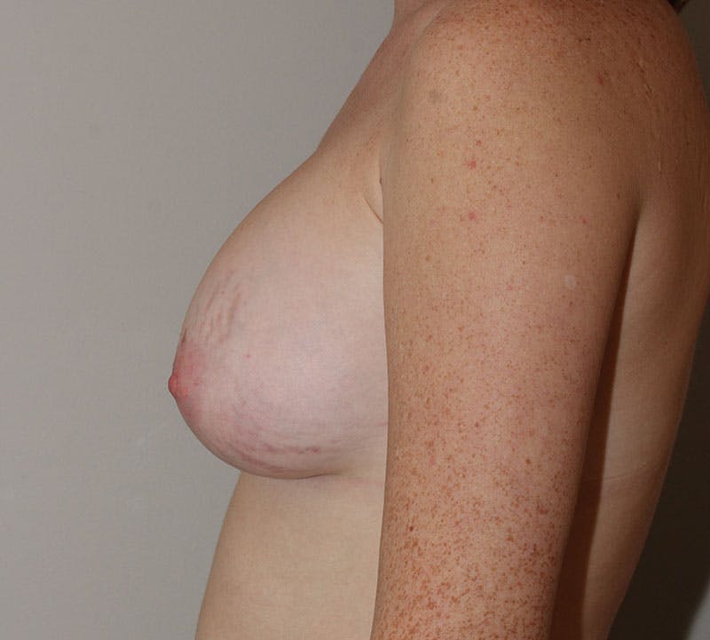 Breast Augmentation Before & After Gallery - Patient 397164 - Image 8