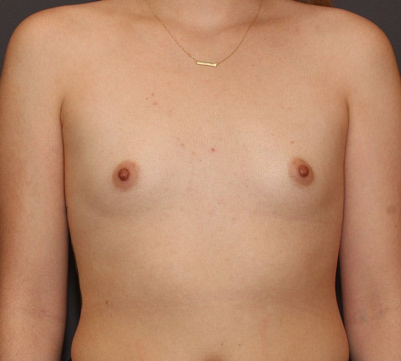 Breast Augmentation Before & After Gallery - Patient 191956 - Image 1