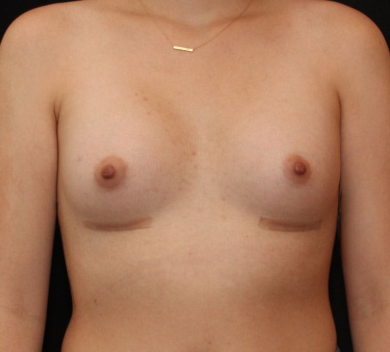 Breast Augmentation Before & After Gallery - Patient 191956 - Image 2