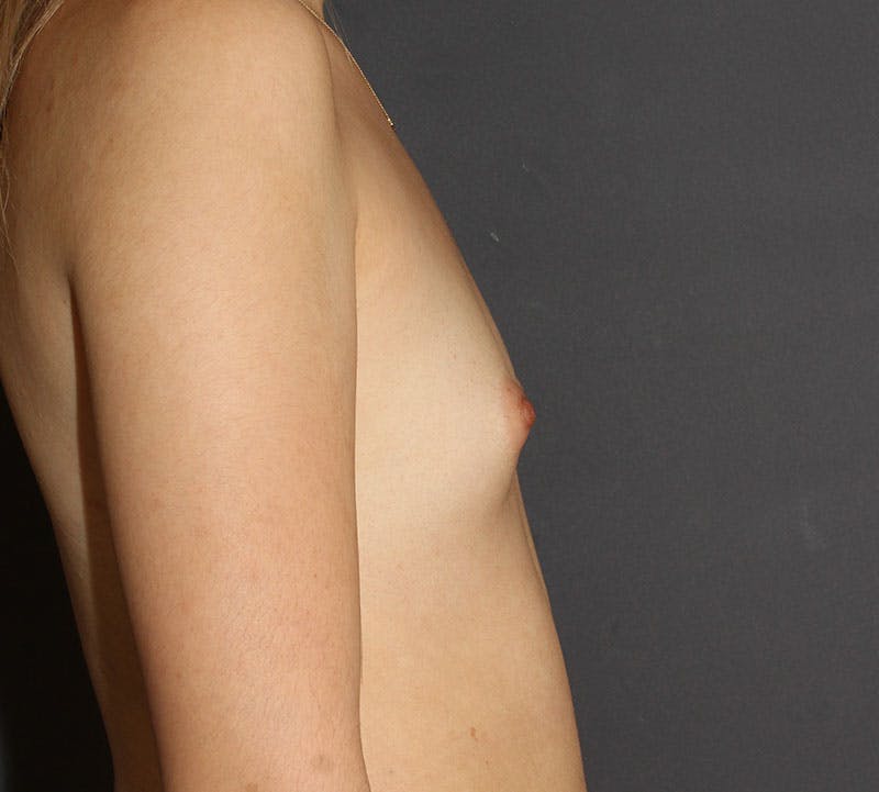 Breast Augmentation Before & After Gallery - Patient 191956 - Image 5