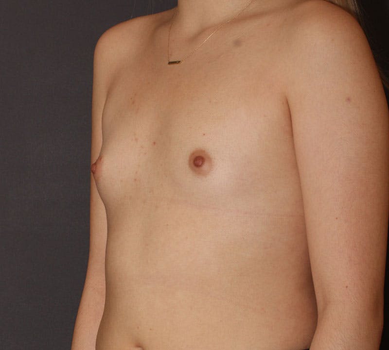Breast Augmentation Before & After Gallery - Patient 191956 - Image 9