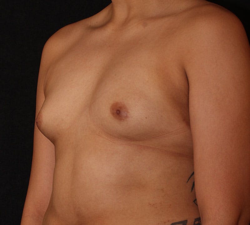 Breast Augmentation Before & After Gallery - Patient 273508 - Image 9