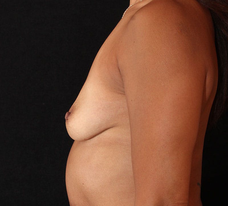 Breast Augmentation Before & After Gallery - Patient 288514 - Image 7