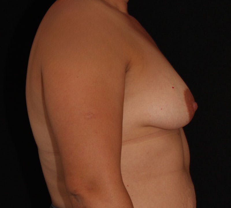 Breast Augmentation Before & After Gallery - Patient 172298 - Image 5