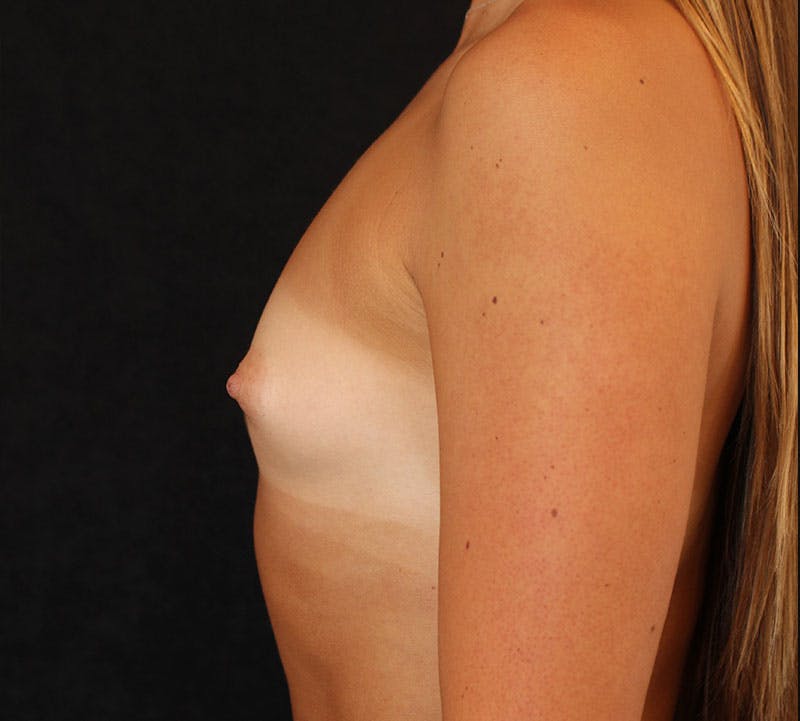 Breast Augmentation Before & After Gallery - Patient 426211 - Image 7