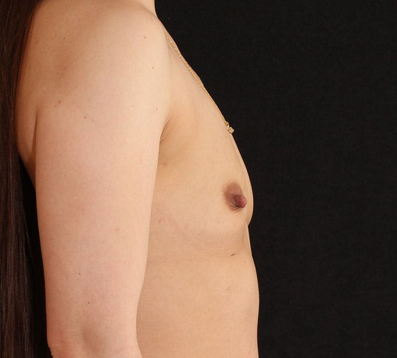 Breast Augmentation Before & After Gallery - Patient 402033 - Image 5