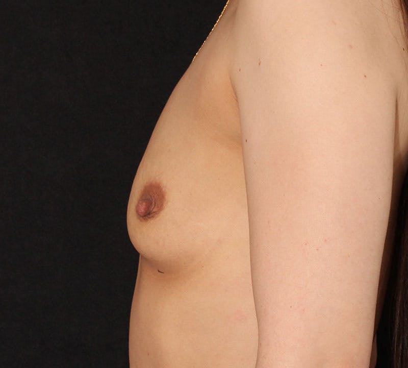 Breast Augmentation Before & After Gallery - Patient 402033 - Image 7