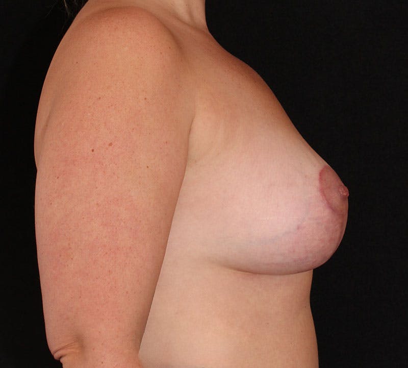 Augmentation-Mastopexy (Implant with Lift) Before & After Gallery - Patient 267832 - Image 6