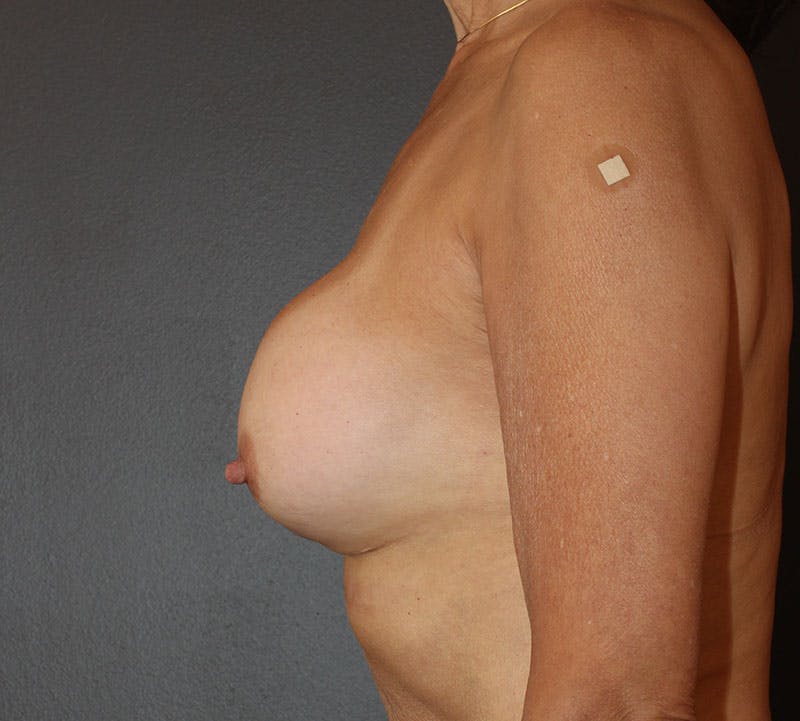 Breast Revision Before & After Gallery - Patient 130482 - Image 7