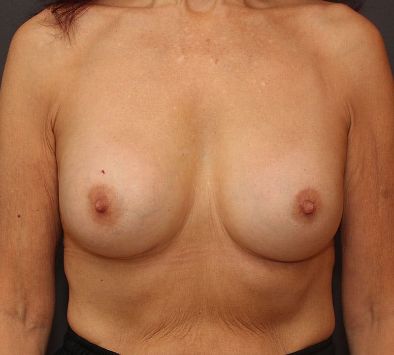Breast Revision Before & After Gallery - Patient 130482 - Image 2