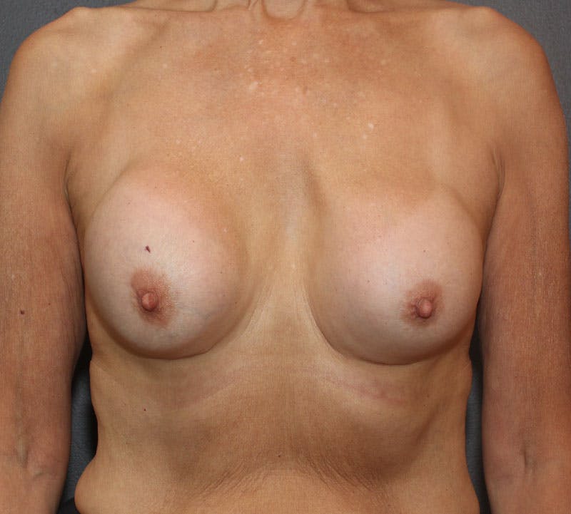 Breast Revision Before & After Gallery - Patient 130482 - Image 1