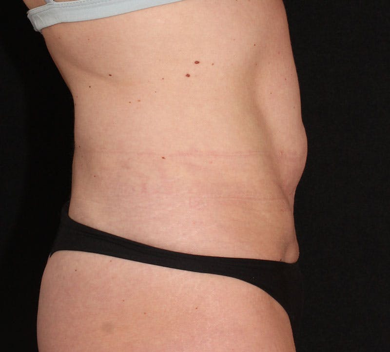 Abdominoplasty (Tummy Tuck) Before & After Gallery - Patient 401715 - Image 5