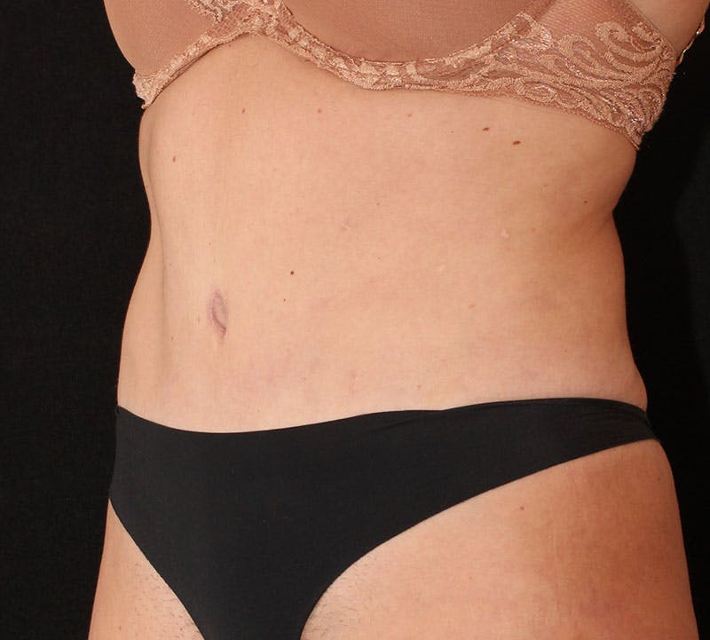 Abdominoplasty (Tummy Tuck) Before & After Gallery - Patient 401715 - Image 10
