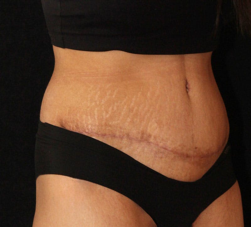 Abdominoplasty (Tummy Tuck) Before & After Gallery - Patient 281108 - Image 4