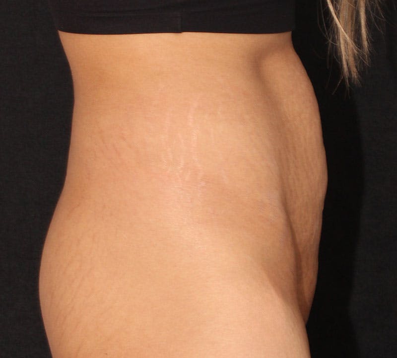 Abdominoplasty (Tummy Tuck) Before & After Gallery - Patient 281108 - Image 5