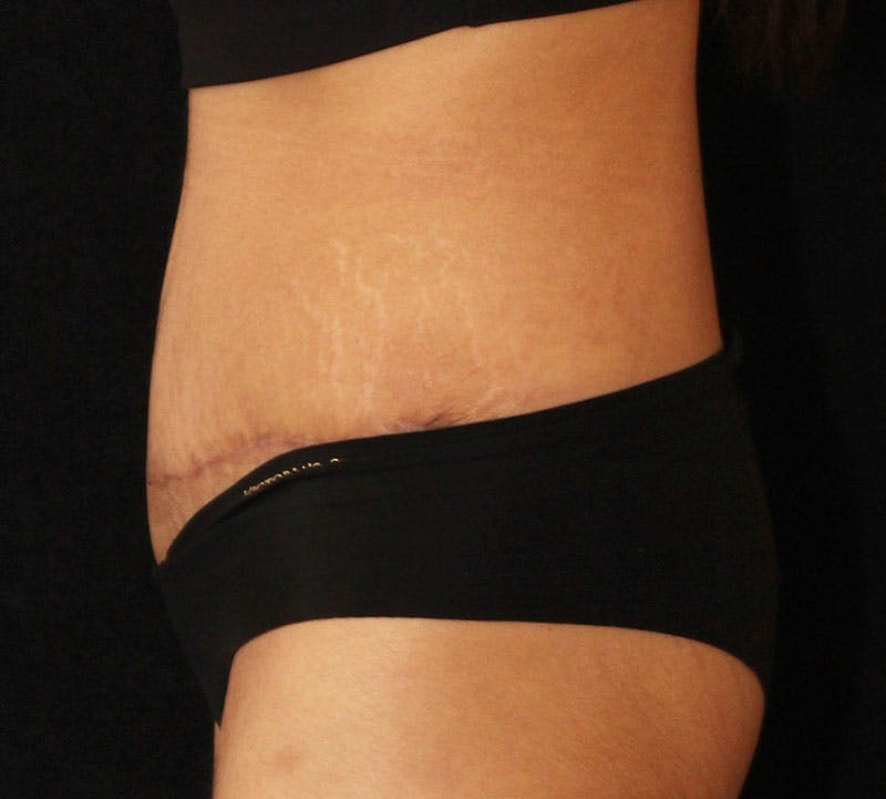 Abdominoplasty (Tummy Tuck) Before & After Gallery - Patient 281108 - Image 8