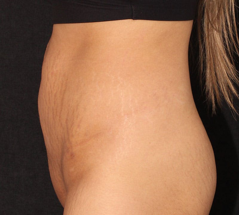 Abdominoplasty (Tummy Tuck) Before & After Gallery - Patient 281108 - Image 7