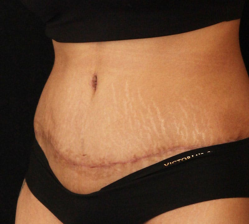Abdominoplasty (Tummy Tuck) Before & After Gallery - Patient 281108 - Image 10