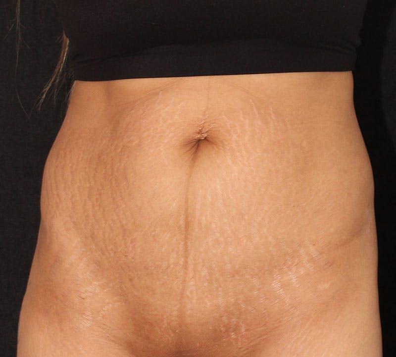 Abdominoplasty (Tummy Tuck) Before & After Gallery - Patient 281108 - Image 9