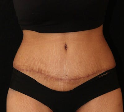Abdominoplasty (Tummy Tuck) Before & After Gallery - Patient 281108 - Image 2