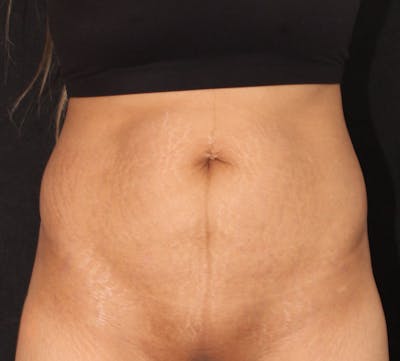 Abdominoplasty (Tummy Tuck) Before & After Gallery - Patient 281108 - Image 1