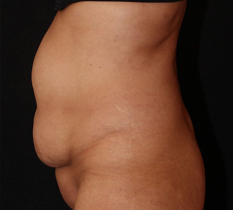 Abdominoplasty (Tummy Tuck) Before & After Gallery - Patient 181160 - Image 7