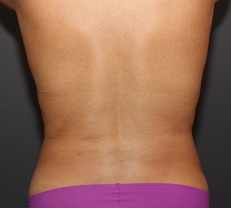 Liposuction Before & After Gallery - Patient 251808 - Image 4