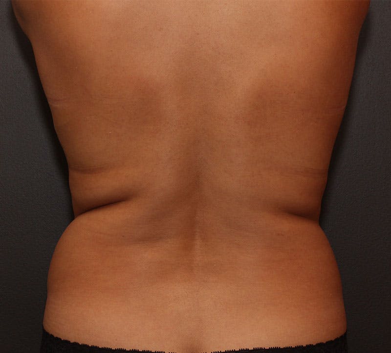 Liposuction Before & After Gallery - Patient 251808 - Image 3