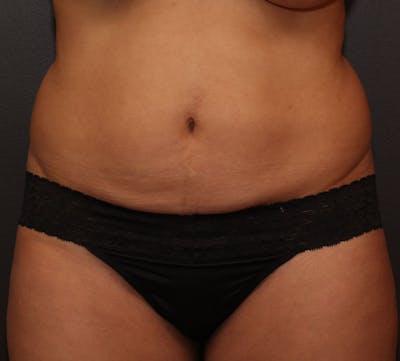 Liposuction Before & After Gallery - Patient 251808 - Image 1