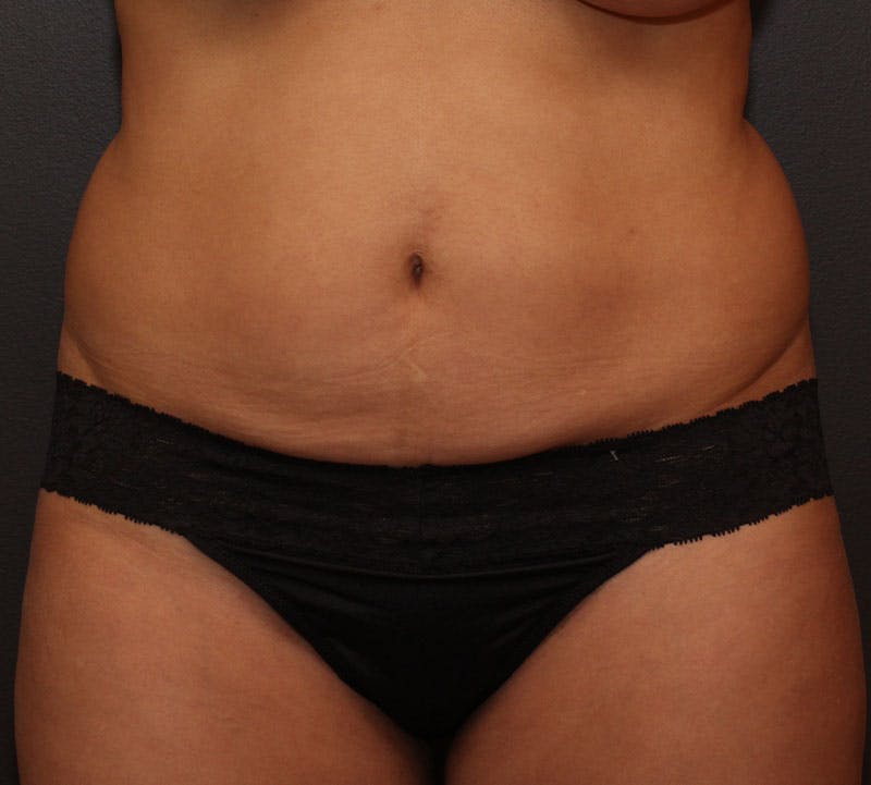 Liposuction Before & After Gallery - Patient 251808 - Image 1