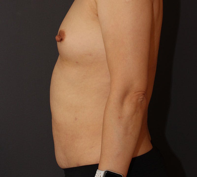 Liposuction Before & After Gallery - Patient 336122 - Image 8