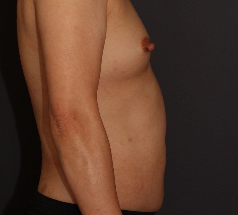 Liposuction Before & After Gallery - Patient 336122 - Image 6