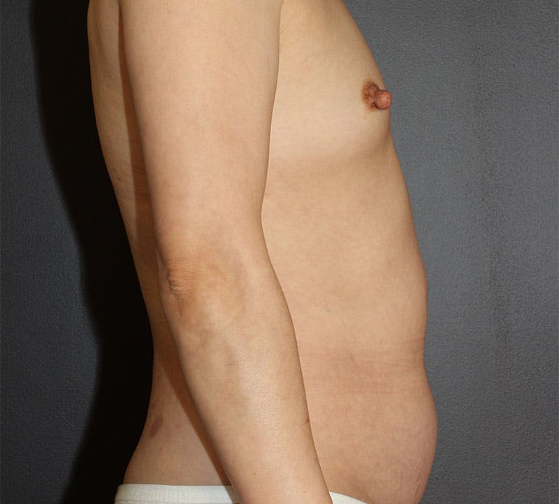 Liposuction Before & After Gallery - Patient 336122 - Image 5
