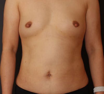 Liposuction Before & After Gallery - Patient 336122 - Image 2
