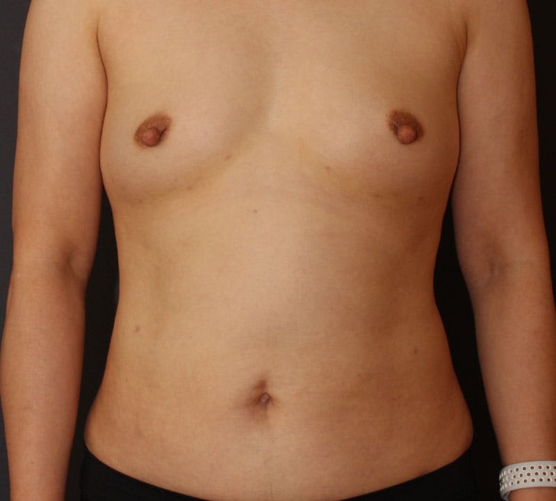 Liposuction Before & After Gallery - Patient 336122 - Image 2