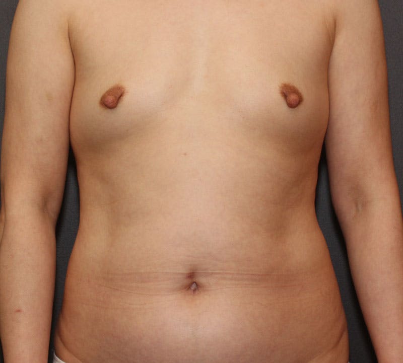 Liposuction Before & After Gallery - Patient 336122 - Image 1