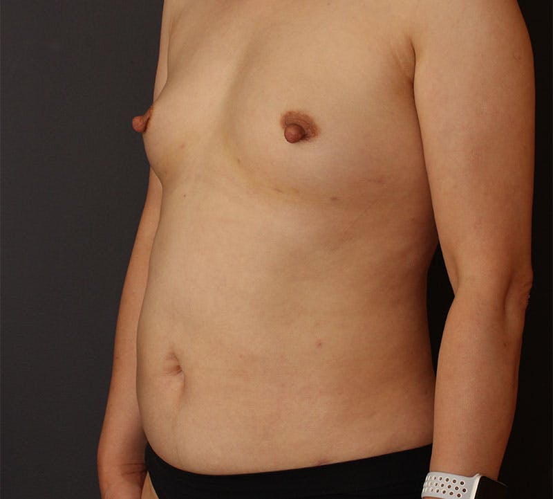 Liposuction Before & After Gallery - Patient 336122 - Image 10