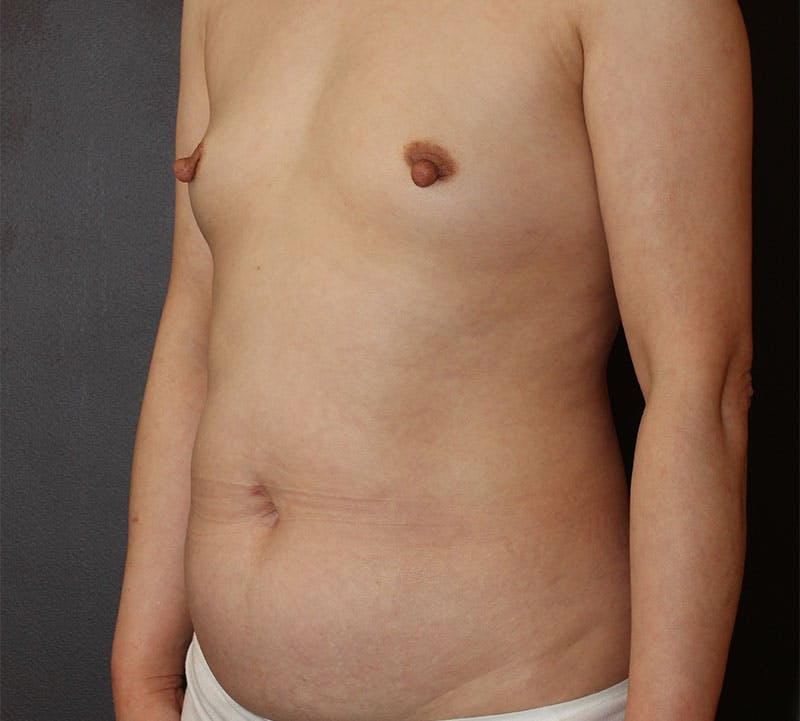 Liposuction Before & After Gallery - Patient 336122 - Image 9