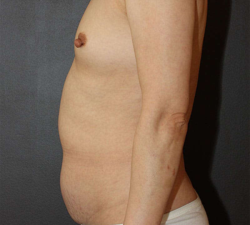 Liposuction Before & After Gallery - Patient 336122 - Image 7