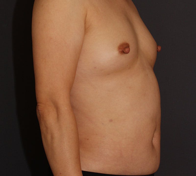 Liposuction Before & After Gallery - Patient 336122 - Image 3