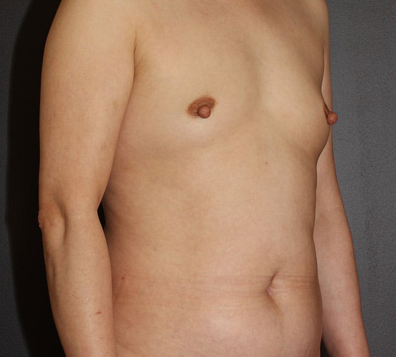 Liposuction Before & After Gallery - Patient 336122 - Image 4