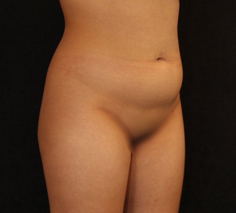 Liposuction Before & After Gallery - Patient 183427 - Image 3